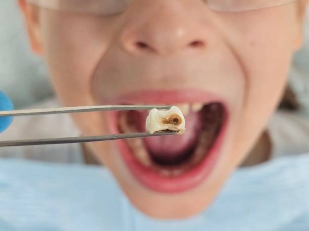 Best Emergency Tooth Extraction in Dent, OH